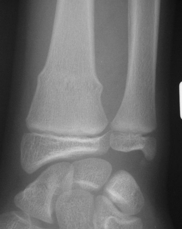 Fig. 71.3.  Fracture en « motte de beurre ».