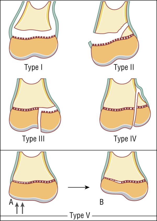 Fig. 71.5.  Traumatismes des cartilages de croissance : classification de Salter et Harris.
