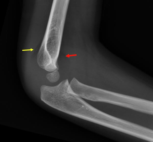 Fig. 71.9.  Épanchement intra-articulaire du coude.