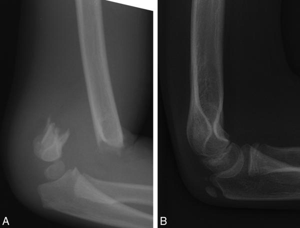 Fig. 71.10.  Fracture supracondylienne du coude à grand déplacement chez un garçon de 6 ans.