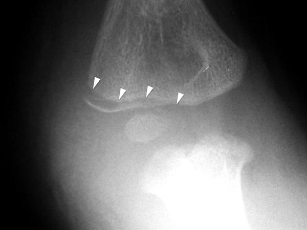 Fig. 71.12.   Fracture du condyle latéral de l’humérus.