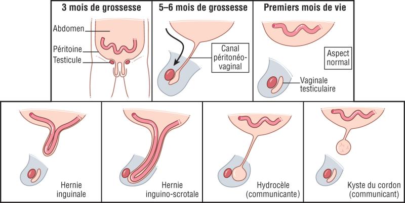 Fig. 22.1. Le canal péritonéovaginal normal et ses différents défauts de fermeture.