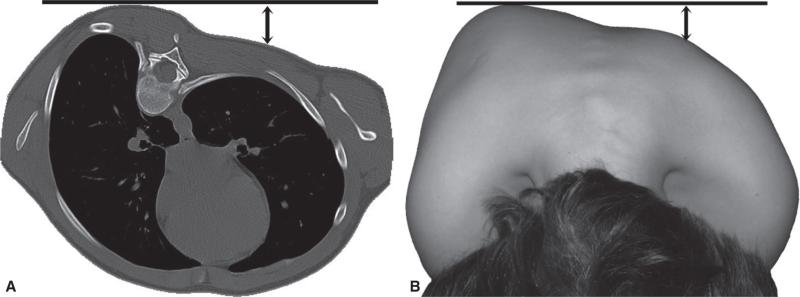 Fig. 4.10. Gibbosité thoracique.