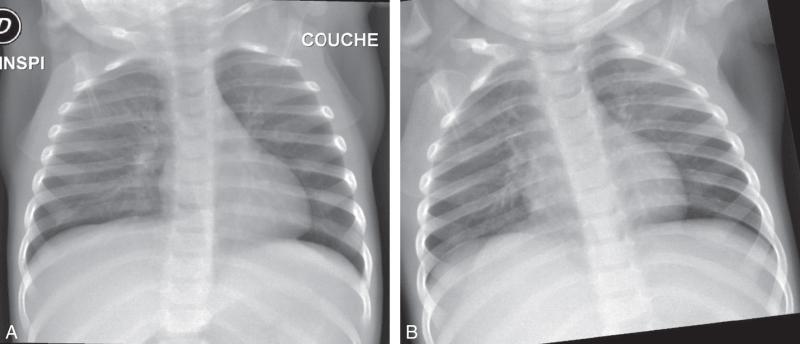 Fig. 54.3. Corps étranger inhalé.