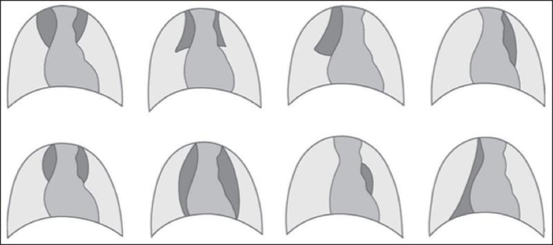 Fig. 60.1. Différents aspects morphologiques du thymus (cliché de face).