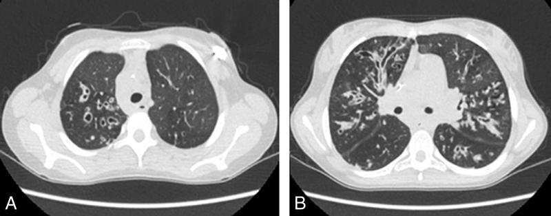 Fig. 63.1. Scanner pulmonaire d’un enfant ayant une mucoviscidose.