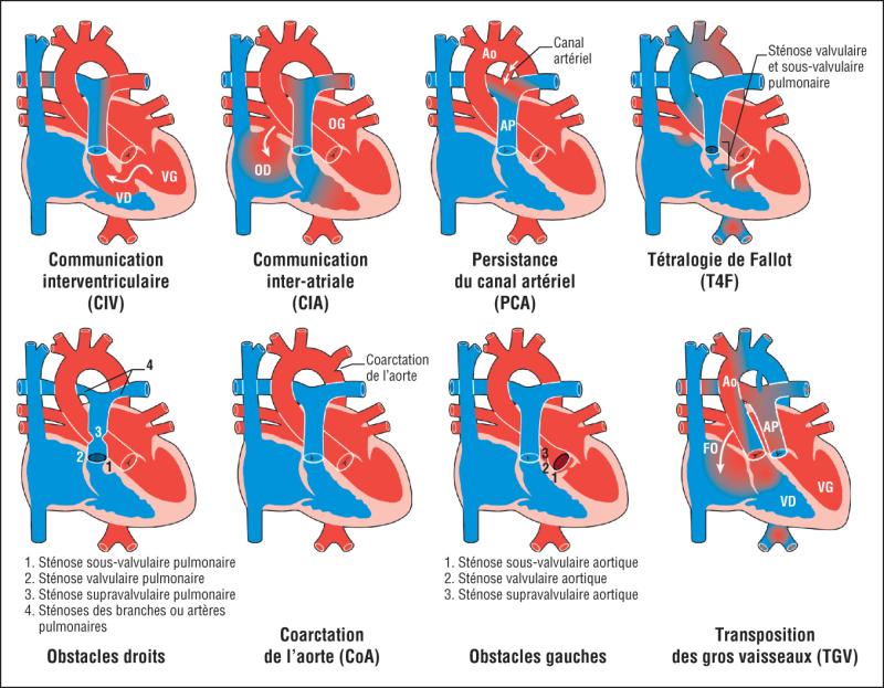 Fig. 64.1. Principales cardiopathies congénitales.
