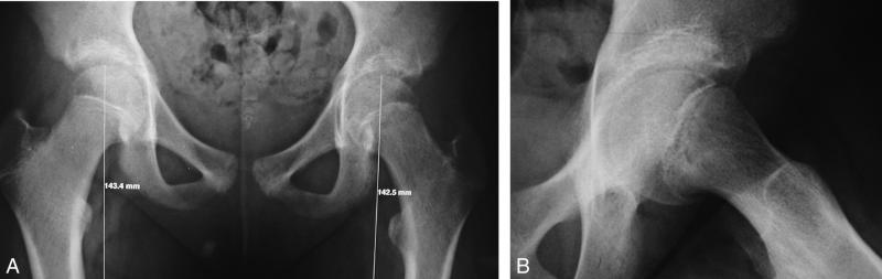 Fig. 70.9. Radiographies du bassin/hanche : épiphysiolyse fémorale supérieure gauche chez une fille de 12 ans.