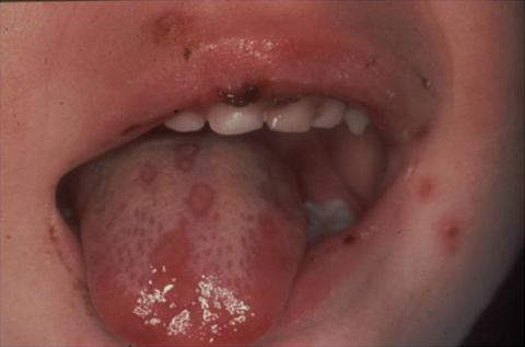 Fig. 38.12. Gingivostomatite herpétique.