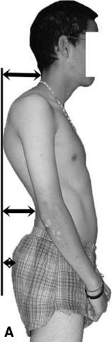 Fig. 4.11. Cyphose de dystrophie rachidienne de croissance.