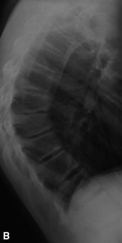 Fig. 4.11. Cyphose de dystrophie rachidienne de croissance.