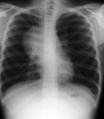 Fig. 60.4. Lymphome.