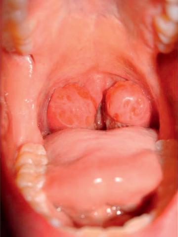 Fig. 62.2. Hypertrophie amygdalienne.