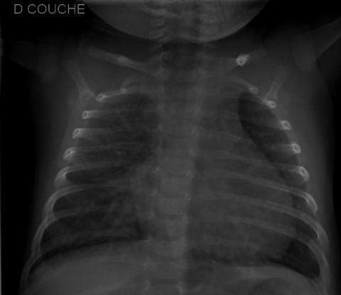 Fig. 64.3. Cardiomégalie chez un enfant avec CIV.